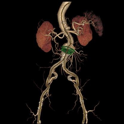 Solution (T)EVAR Assist de GE Santé