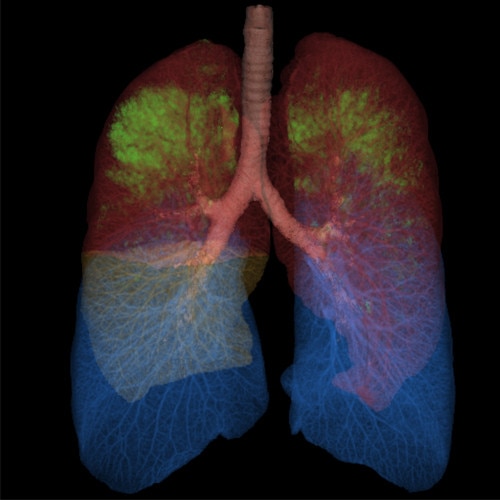 lungs vcar thoraciques