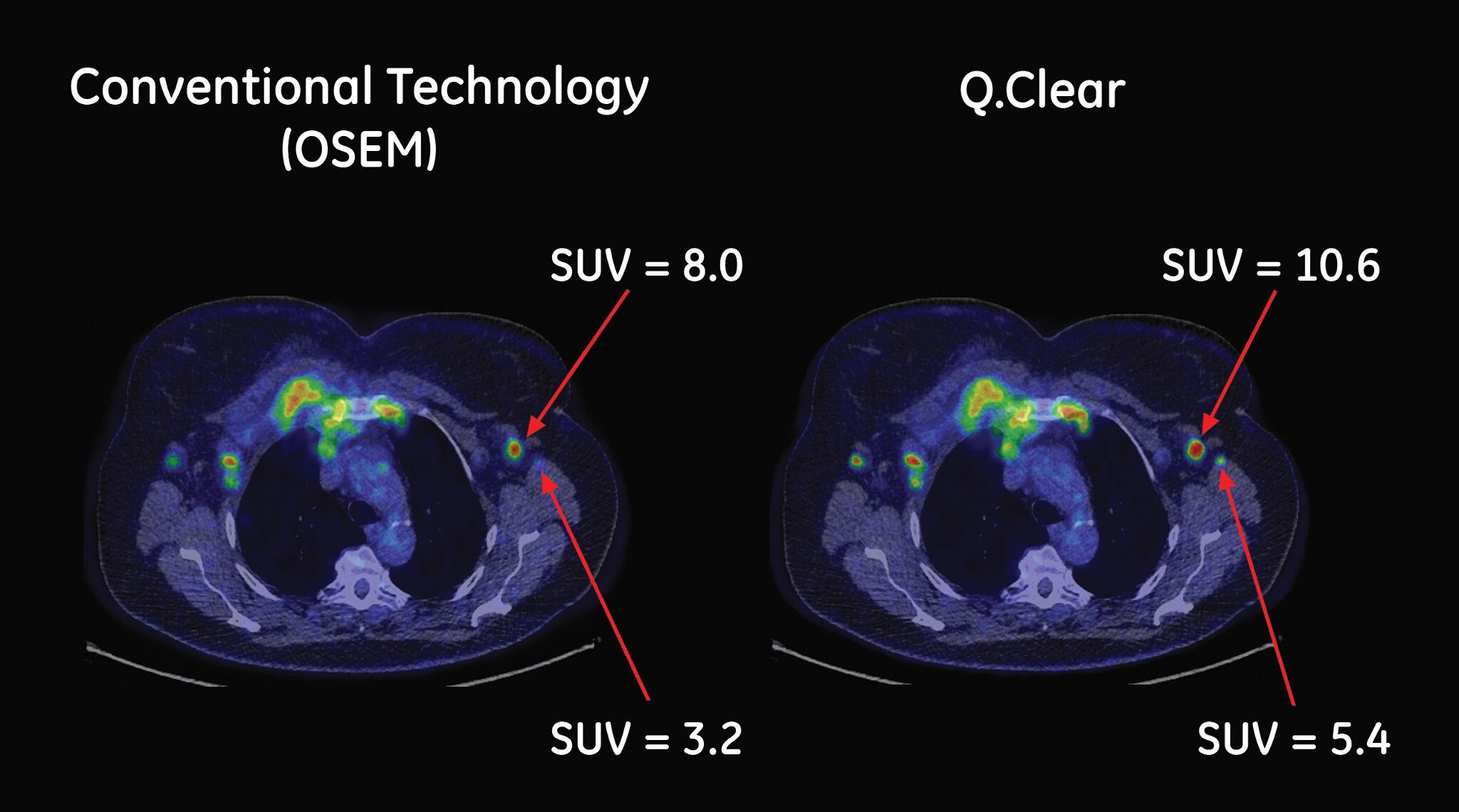 Comparaison entre la technologie Q.Clear et conventionnelle (reconstruction OSEM standard)