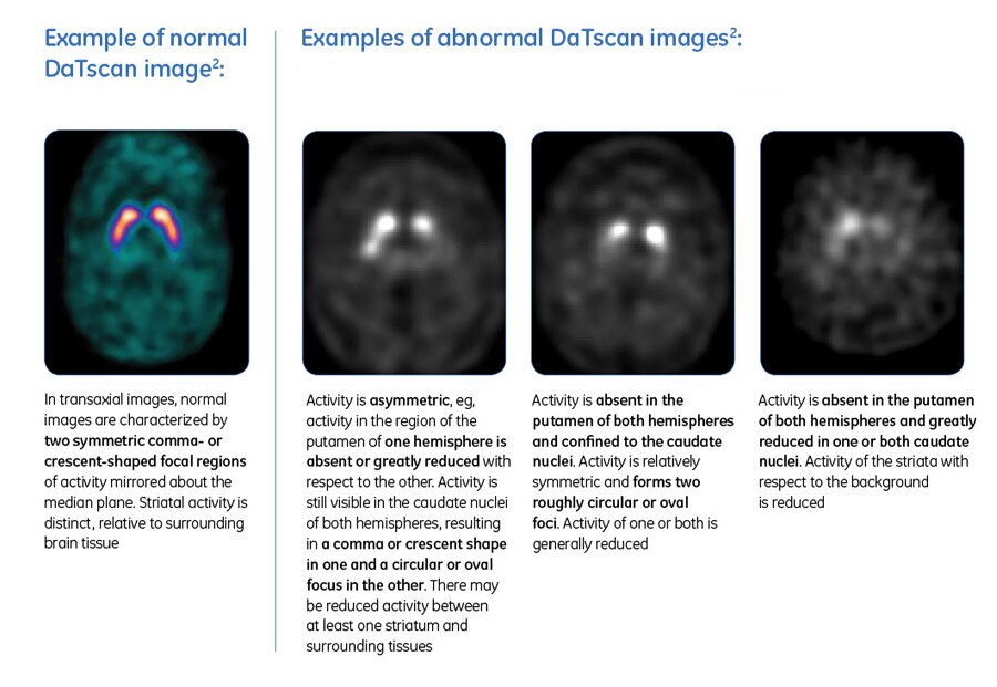 DaTscan GE Healthcare