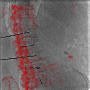 ct-categories-interventional-x-ray-igs-for-hybrid-or-discovery igs 730-needle-assist-2.jpg
